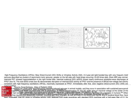 After the seizure has been viewed using conventional frequencies and muscle activity has been removed, a search for baseline shifts should be performed.