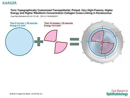 Toric Topographically Customized Transepithelial, Pulsed, Very High-Fluence, Higher Energy and Higher Riboflavin Concentration Collagen Cross-Linking in.