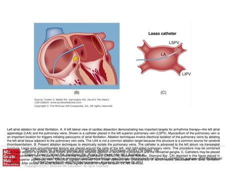 Left atrial ablation for atrial fibrillation. A