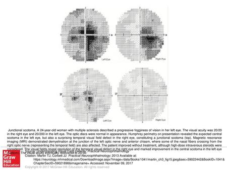 Junctional scotoma. A 24-year-old woman with multiple sclerosis described a progressive fogginess of vision in her left eye. The visual acuity was 20/20.