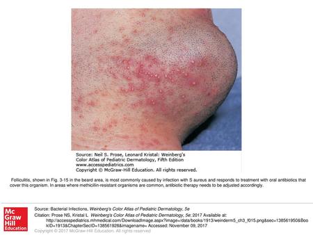 Folliculitis, shown in Fig