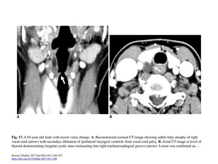 Fig. 17. A 54-year-old male with recent voice change. A