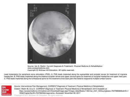 Lead implantation for peripheral nerve stimulation (PNS)