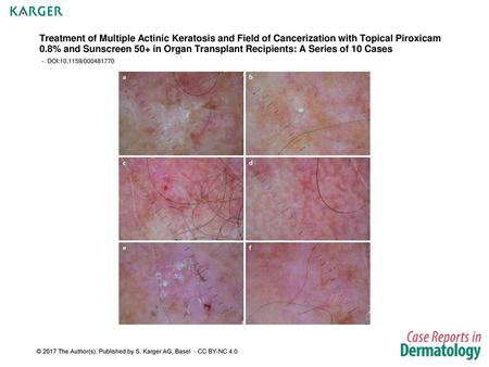 Treatment of Multiple Actinic Keratosis and Field of Cancerization with Topical Piroxicam 0.8% and Sunscreen 50+ in Organ Transplant Recipients: A Series.