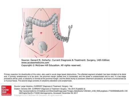 Primary resection for diverticulitis of the colon, also used in acute large bowel obstructions. The affected segment (shaded) has been divided at its distal.