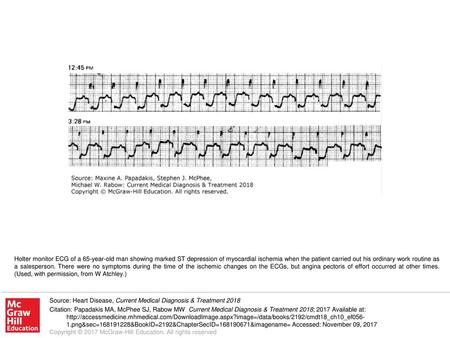 Holter monitor ECG of a 65-year-old man showing marked ST depression of myocardial ischemia when the patient carried out his ordinary work routine as a.