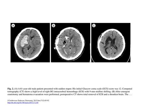 Fig. 2. (A) A 61-year-old male patient presented with sudden stupor