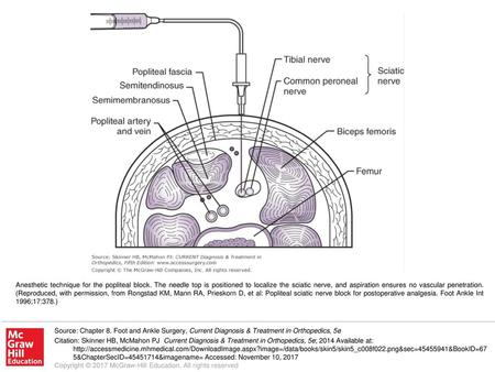 Anesthetic technique for the popliteal block