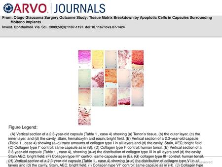 From: Otago Glaucoma Surgery Outcome Study: Tissue Matrix Breakdown by Apoptotic Cells in Capsules Surrounding Molteno Implants Invest. Ophthalmol. Vis.