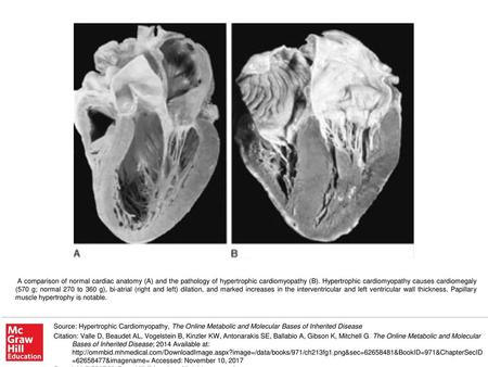 A comparison of normal cardiac anatomy (A) and the pathology of hypertrophic cardiomyopathy (B). Hypertrophic cardiomyopathy causes cardiomegaly (570 g;