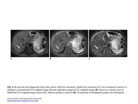 Fig year-old man diagnosed with colon cancer with liver metastasis