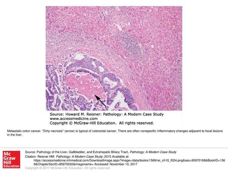 Metastatic colon cancer