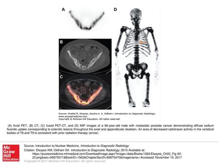 (A) Axial PET, (B) CT, (C) fused PET-CT, and (D) MIP images of a 68-year-old male with metastatic prostate cancer demonstrating diffuse sodium fluoride.