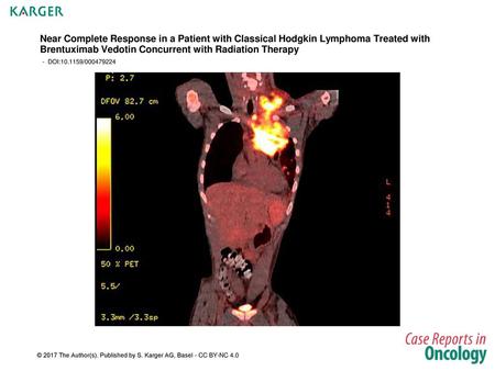 Near Complete Response in a Patient with Classical Hodgkin Lymphoma Treated with Brentuximab Vedotin Concurrent with Radiation Therapy - DOI:10.1159/000479224.