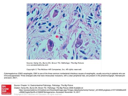 Cytomegalovirus (CMV) esophagitis