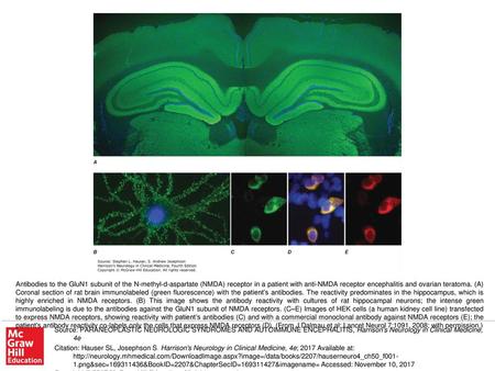 Antibodies to the GluN1 subunit of the N-methyl-d-aspartate (NMDA) receptor in a patient with anti-NMDA receptor encephalitis and ovarian teratoma. (A)