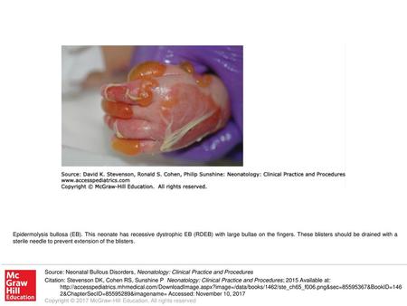 Epidermolysis bullosa (EB)