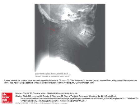 Lateral view of the c-spine show traumatic spondylolisthesis of C2 upon C3. This “hangman’s” fracture (arrow) resulted from a high-speed MVA where the.