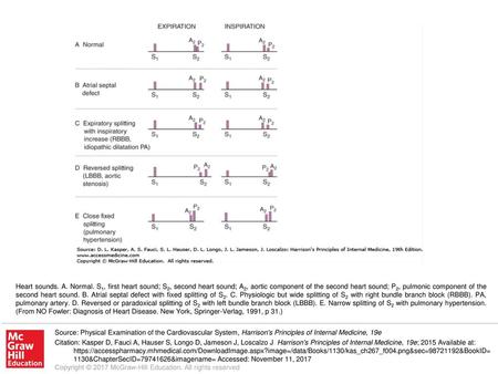 Heart sounds. A. Normal. S1, first heart sound; S2, second heart sound; A2, aortic component of the second heart sound; P2, pulmonic component of the second.