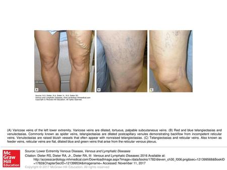 (A) Varicose veins of the left lower extremity