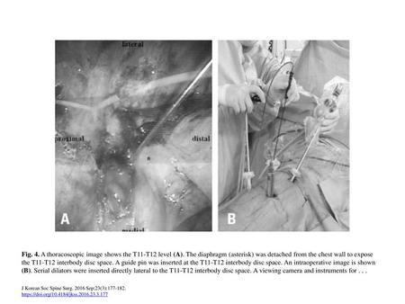 Fig. 4. A thoracoscopic image shows the T11-T12 level (A)