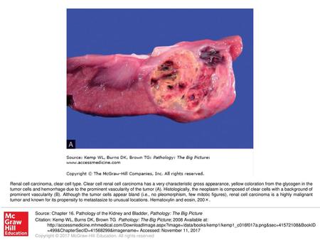 Renal cell carcinoma, clear cell type