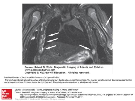 There is hyperintensity along the surface of the humerus (arrow) due to subperiosteal hemorrhage. The marrow signal is normal. Edema is present within.