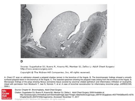 A. Chest CT scan on admission showed a polypoid shadow (arrow) in the bronchus of the lingula. B. The bronchoscopic findings showed a smooth-surfaced polypoid.