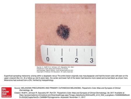 Superficial spreading melanoma: arising within a dysplastic nevus The entire lesion originally was maculopapular and had the brown color still seen on.