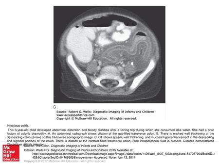 This 3-year-old child developed abdominal distention and bloody diarrhea after a fishing trip during which she consumed lake water. She had a prior history.