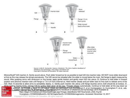 Mirena/Skyla® IUD insertion A. Gently sound uterus