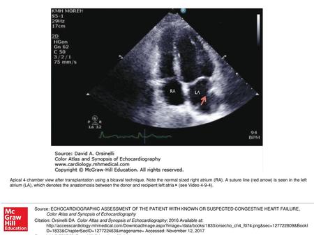 Apical 4 chamber view after transplantation using a bicaval technique