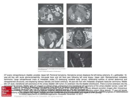 CT scans: retroperitoneum, bladder, prostate