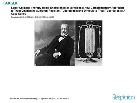 Lobar Collapse Therapy Using Endobronchial Valves as a New Complementary Approach to Treat Cavities in Multidrug-Resistant Tuberculosis and Difficult-to-Treat.