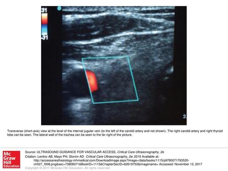 Transverse (short-axis) view at the level of the internal jugular vein (to the left of the carotid artery and not shown). The right carotid artery and.