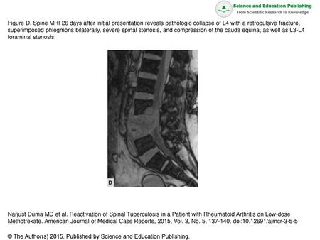 Figure D. Spine MRI 26 days after initial presentation reveals pathologic collapse of L4 with a retropulsive fracture, superimposed phlegmons bilaterally,