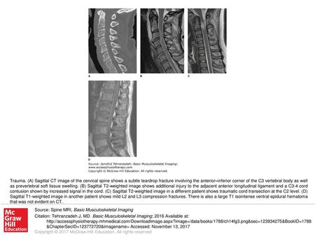 Trauma. (A) Sagittal CT image of the cervical spine shows a subtle teardrop fracture involving the anterior–inferior corner of the C3 vertebral body as.