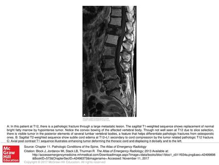 A: In this patient at T12, there is a pathologic fracture through a large metastatic lesion. The sagittal T1-weighted sequence shows replacement of normal.