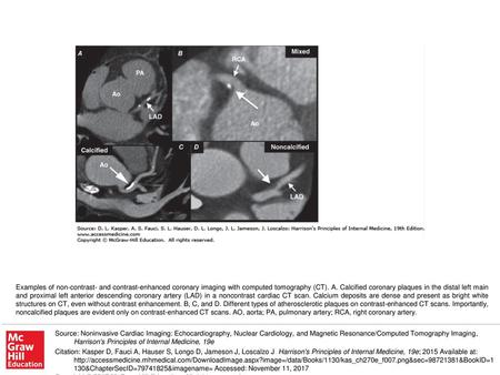 Examples of non-contrast- and contrast-enhanced coronary imaging with computed tomography (CT). A. Calcified coronary plaques in the distal left main and.