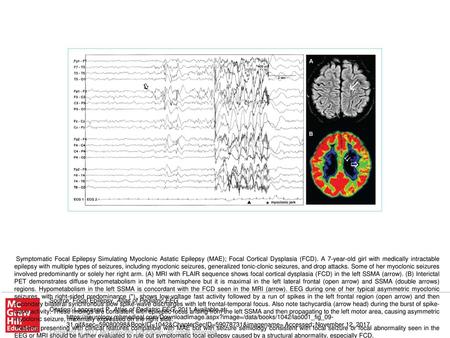 Patients presenting with clinical features compatible with MAE but with seizure semiology consistent with focal seizure or focal abnormality seen in the.