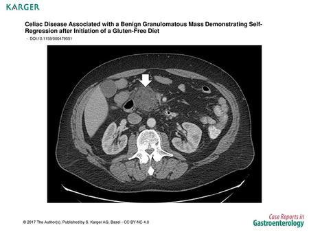 Celiac Disease Associated with a Benign Granulomatous Mass Demonstrating Self-Regression after Initiation of a Gluten-Free Diet - DOI:10.1159/000479551.