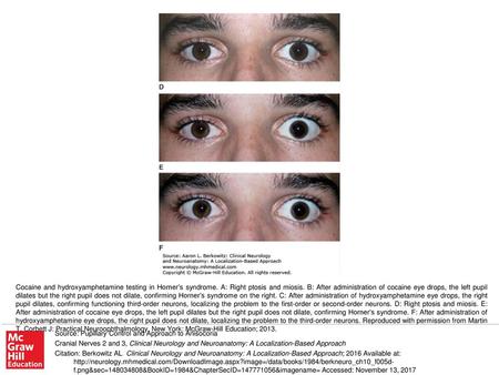 Cocaine and hydroxyamphetamine testing in Horner’s syndrome