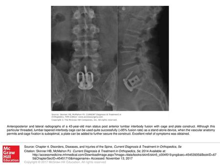 Anteroposterior and lateral radiographs of a 43-year-old man status post anterior lumbar interbody fusion with cage and plate construct. Although this.