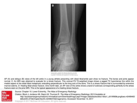 AP (A) and oblique (B) views of the left ankle in a young athlete presenting with distal tibial/ankle pain show no fracture. The bones and joints appear.