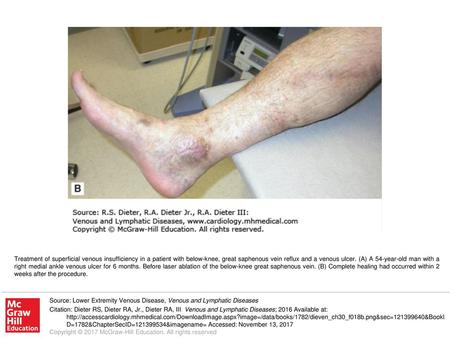 Treatment of superficial venous insufficiency in a patient with below-knee, great saphenous vein reflux and a venous ulcer. (A) A 54-year-old man with.