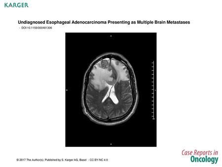 Undiagnosed Esophageal Adenocarcinoma Presenting as Multiple Brain Metastases - DOI:10.1159/000481306 Fig. 1. MRI-brain T2-weighted image showing an anterior.