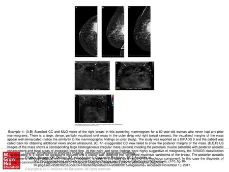 Example 4: (A,B) Standard CC and MLO views of the right breast in this screening mammogram for a 60-year-old woman who never had any prior mammograms.