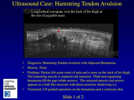 Ultrasound Case: Hamstring Tendon Avulsion