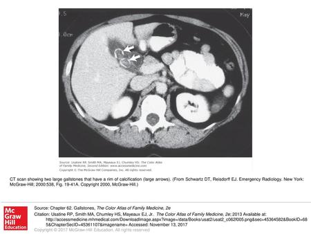 CT scan showing two large gallstones that have a rim of calcification (large arrows). (From Schwartz DT, Reisdorff EJ. Emergency Radiology. New York: McGraw-Hill;