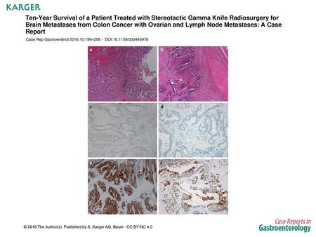 Ten-Year Survival of a Patient Treated with Stereotactic Gamma Knife Radiosurgery for Brain Metastases from Colon Cancer with Ovarian and Lymph Node Metastases: